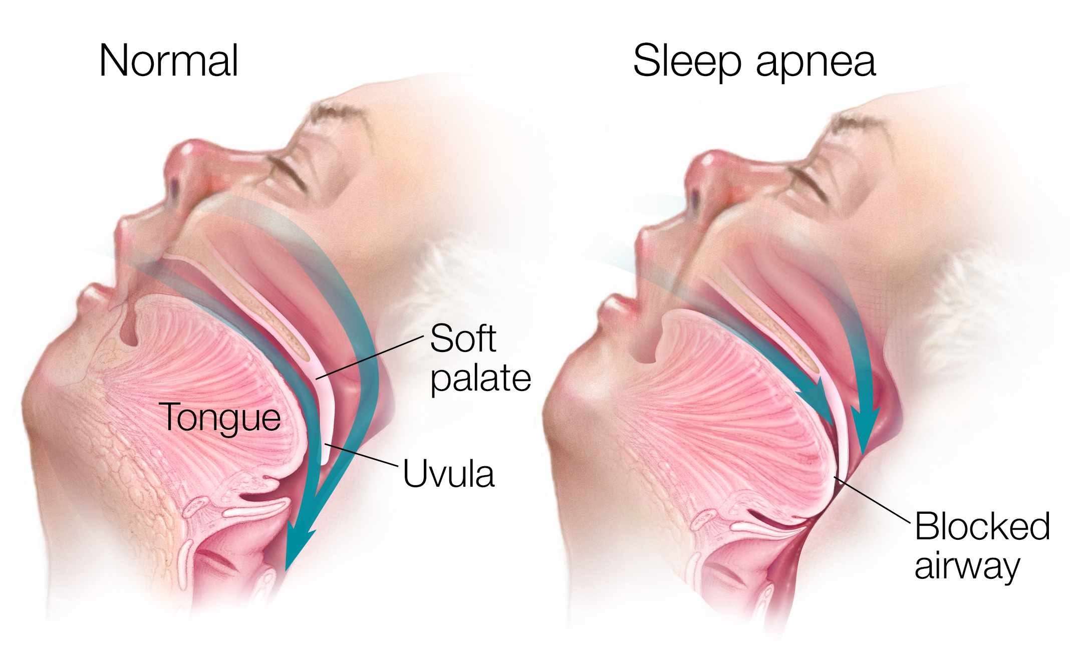 Medical illustration of sleep apnea